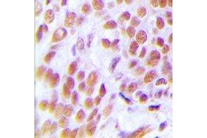 Immunohistochemical analysis of ZNF265 staining in human breast cancer formalin fixed paraffin embedded tissue section. (ZNF265 抗体)