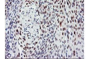 Immunohistochemical staining of paraffin-embedded Carcinoma of Human bladder tissue using anti-BACH1 mouse monoclonal antibody. (BACH1 抗体)