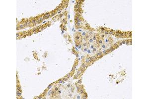 Immunohistochemistry of paraffin-embedded Human thyroid cancer using FHL1 Polyclonal Antibody at dilution of 1:100 (40x lens). (FHL1 抗体)