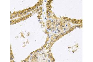 Immunohistochemistry of paraffin-embedded Human thyroid cancer using FHL1 Polyclonal Antibody at dilution of 1:100 (40x lens).