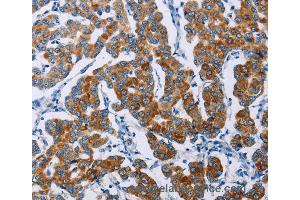 Immunohistochemistry of Human thyroid cancer using NCR3 Polyclonal Antibody at dilution of 1:40 (NCR3 抗体)
