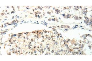 Immunohistochemistry of paraffin-embedded Human breast cancer using TPM2 Polyclonal Antibody at dilution of 1:60 (TPM2 抗体)