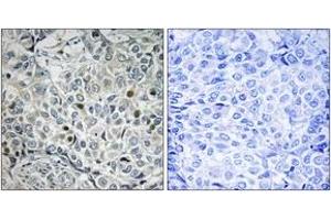 Immunohistochemistry analysis of paraffin-embedded human breast carcinoma, using USP53 Antibody. (USP53 抗体  (AA 951-1000))