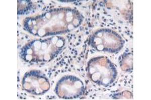 IHC-P analysis of Human Stomach Cancer Tissue, with DAB staining. (ATP6AP2 抗体  (AA 17-302))