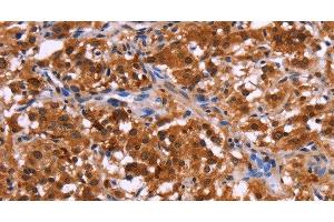 Immunohistochemistry of paraffin-embedded Human thyroid cancer tissue using USP2 Polyclonal Antibody at dilution 1:40 (USP2 抗体)