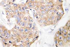 Immunohistochemistry analysis of CD213a1 / IL13RA1 Antibody in paraffin-embedded human breast carcinoma tissue. (IL13 Receptor alpha 1 抗体)