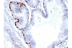 Formalin-fixed, paraffin-embedded human Prostate Carcinoma stained with Cystatin A Mouse Monoclonal Antibody (CPTC-CSTA-1). (CSTA 抗体)