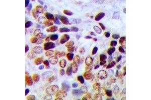 Immunohistochemical analysis of CBP20 staining in human prostate cancer formalin fixed paraffin embedded tissue section. (NCBP2 抗体  (N-Term))