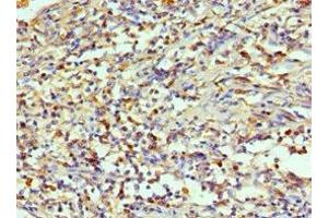 Immunohistochemistry of paraffin-embedded human cervical cancer using ABIN7143994 at dilution of 1:100 (AIMP1 抗体  (AA 25-180))