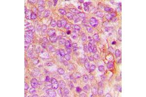 Immunohistochemical analysis of MDA5 staining in human breast cancer formalin fixed paraffin embedded tissue section. (IFIH1 抗体  (C-Term))