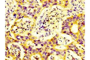IHC image of ABIN7150786 diluted at 1:600 and staining in paraffin-embedded human bladder cancer performed on a Leica BondTM system. (DUSP9 抗体  (AA 142-263))