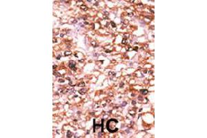 Formalin-fixed and paraffin-embedded human hepatocellular carcinoma tissue reacted with ACVR2B polyclonal antibody  , which was peroxidase-conjugated to the secondary antibody, followed by AEC staining. (ACVR2B 抗体  (N-Term))
