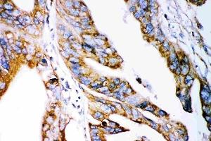 Anti-Claudin 2 antibody, (ABIN3042751), IHC(P)IHC(P): Human Intestinal Cancer Tissue (Claudin 2 抗体  (AA 38-230))