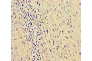 Immunohistochemistry of paraffin-embedded human liver cancer using ABIN7168865 at dilution of 1:100 (Septin 2 抗体  (AA 1-361))