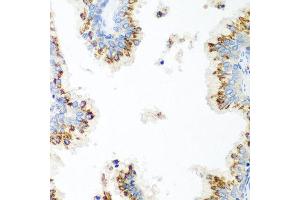 Immunohistochemistry of paraffin-embedded human prostate using UBIAD1 antibody at dilution of 1:100 (40x lens). (UBIAD1 抗体)