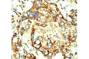 IHC analysis of FFPE human hepatocarcinoma stained with the Dnmt2 antibody (Dnmt2 抗体  (AA 346-375))