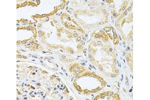 Immunohistochemistry of paraffin-embedded Human kidney cancer using VAPB Polyclonal Antibody at dilution of 1:200 (40x lens). (VAPB 抗体)