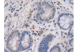 Detection of TGFb2 in Human Stomach cancer Tissue using Polyclonal Antibody to Transforming Growth Factor Beta 2 (TGFb2)