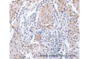 Immunohistochemistry of Human lung cancer using APEX1 Polyclonal Antibody at dilution of 1:20 (APEX1 抗体)