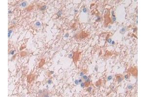 DAB staining on IHC-P; Samples: Human Glioma Tissue (VWA3A 抗体  (AA 981-1176))