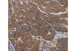 Immunohistochemistry of Human cervical cancer using PARP10 Polyclonal Antibody at dilution of 1:30 (PARP10 抗体)
