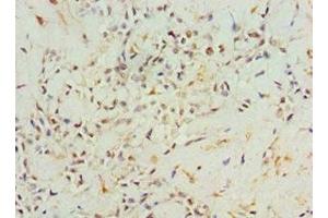 Immunohistochemistry of paraffin-embedded human breast cancer using ABIN7144316 at dilution of 1:100 (AGR2 抗体  (AA 21-175))