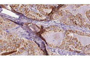 ABIN6267091 at 1/100 staining Human thyroid cancer tissue by IHC-P. (TBC1D4 抗体  (pSer318))