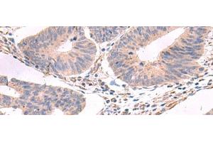 Immunohistochemistry of paraffin-embedded Human colorectal cancer tissue using GKAP1 Polyclonal Antibody at dilution of 1:95(x200) (GKAP1 抗体)
