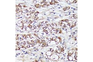Immunohistochemistry (IHC) image for anti-Methylenetetrahydrofolate Dehydrogenase (NADP+ Dependent) 2, Methenyltetrahydrofolate Cyclohydrolase (MTHFD2) (AA 40-250) antibody (ABIN6144144)