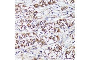 Immunohistochemistry of paraffin-embedded human liver cancer using MTHFD2 antibody (ABIN6132367, ABIN6144144, ABIN6144145 and ABIN6214625) at dilution of 1:100 (40x lens). (MTHFD2 抗体  (AA 40-250))