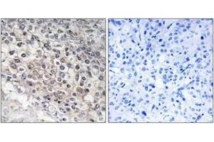 Immunohistochemistry analysis of paraffin-embedded human liver carcinoma tissue, using Cytochrome P450 2W1 Antibody. (CYP2W1 抗体  (AA 311-360))