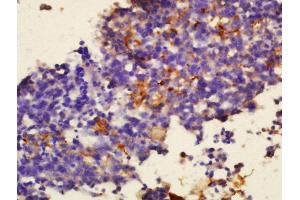 Formalin-fixed and paraffin embedded human glioma tissue labeled with Anti-Sialoadhesin Polyclonal Antibody, Unconjugated (ABIN2179210) at 1:300 followed by conjugation to the secondary antibody and DAB staining. (Sialoadhesin/CD169 抗体  (AA 851-950))