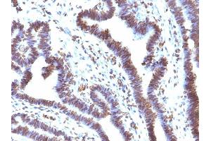 Formalin-fixed, paraffin-embedded human Ovarian Carcinoma stained with EMI1 Mouse Monoclonal Antibody (EMI1/1176). (FBXO5 抗体  (AA 1-250))