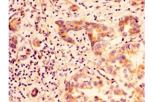 IHC image of ABIN7153857 diluted at 1:100 and staining in paraffin-embedded human liver cancer performed on a Leica BondTM system. (GLIPR1 抗体  (AA 22-232))