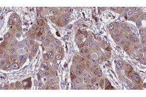 ABIN6276641 at 1/100 staining Human liver cancer tissue by IHC-P. (F11R 抗体  (C-Term))