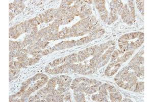IHC-P Image Immunohistochemical analysis of paraffin-embedded human colon carcinoma, using GSTA1, antibody at 1:250 dilution. (GSTA1 抗体)