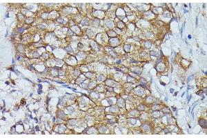 Immunohistochemistry of paraffin-embedded Human mammary cancer using CTTN Polyclonal Antibody at dilution of 1:100 (40x lens). (Cortactin 抗体)