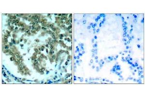 Immunohistochemical analysis of paraffin-embedded human lung carcinoma tissue, using PKCθ (Ab-676) antibody (E021289). (PKC theta 抗体)