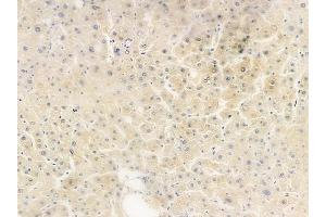 ABIN6261012 and ABIN6279255 at 1/100 staining human hepatocellular carcinoma by IHC-P.