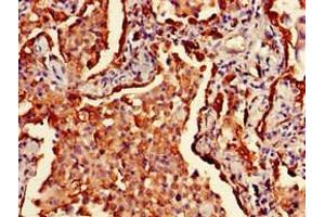 Immunohistochemistry of paraffin-embedded human lung cancer using ABIN7155618 at dilution of 1:100 (HLA-DRB1 抗体  (AA 31-266) (Biotin))