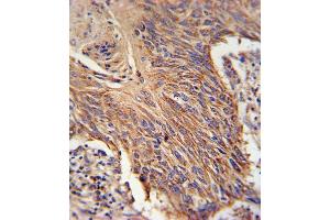 RDH10 Antibody (Center) (ABIN650935 and ABIN2840001) immunohistochemistry analysis in formalin fixed and paraffin embedded lung carcinoma followed by peroxidase conjugation of the secondary antibody and DAB staining. (RDH10 抗体  (AA 106-135))