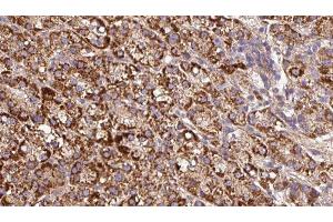 ABIN6279676 at 1/100 staining Human liver cancer tissue by IHC-P. (Kcne3 抗体  (Internal Region))