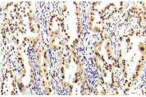 Immunohistochemistry (IHC) analyzes of STAT-5A antibody in paraffin-embedded human lung carcinoma tissue. (STAT5A 抗体)