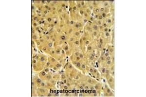 FBP1 Antibody (N-term) (ABIN391576 and ABIN2841511) IHC analysis in formalin fixed and paraffin embedded human hepatocarcinoma followed by peroxidase conjugation of the secondary antibody and DAB staining. (FBP1 抗体  (N-Term))
