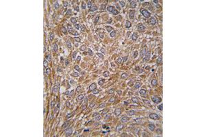 Formalin-fixed and paraffin-embedded human lung carcinoma tissue reacted with GIT1 Antibody (Y510) , which was peroxidase-conjugated to the secondary antibody, followed by DAB staining. (GIT1 抗体  (AA 487-517))