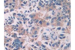 Immunohistochemistry (IHC) image for anti-PTK7 Protein tyrosine Kinase 7 (PTK7) (AA 853-1070) antibody (ABIN7445414)