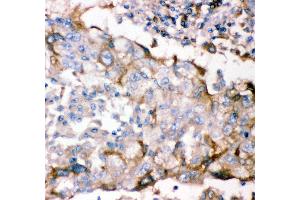 Anti- GFRA1 antibody, IHC(P) IHC(P): Human Lung Cancer Tissue (GFRA1 抗体  (AA 25-227))