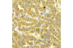 Immunohistochemistry of paraffin-embedded human thyroid cancer using DLD Antibody. (DLD 抗体  (AA 36-300))