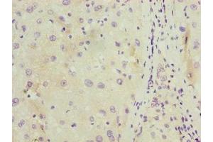 Immunohistochemistry of paraffin-embedded human liver cancer using ABIN7174715 at dilution of 1:100 (C11orf53 抗体  (AA 13-236))
