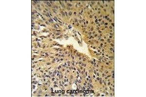 COG2 Antibody (N-term) (R) IHC analysis in formalin fixed and paraffin embedded human Lung carcinoma followed by peroxidase conjugation of the secondary antibody and DAB staining. (COG2 抗体  (N-Term))